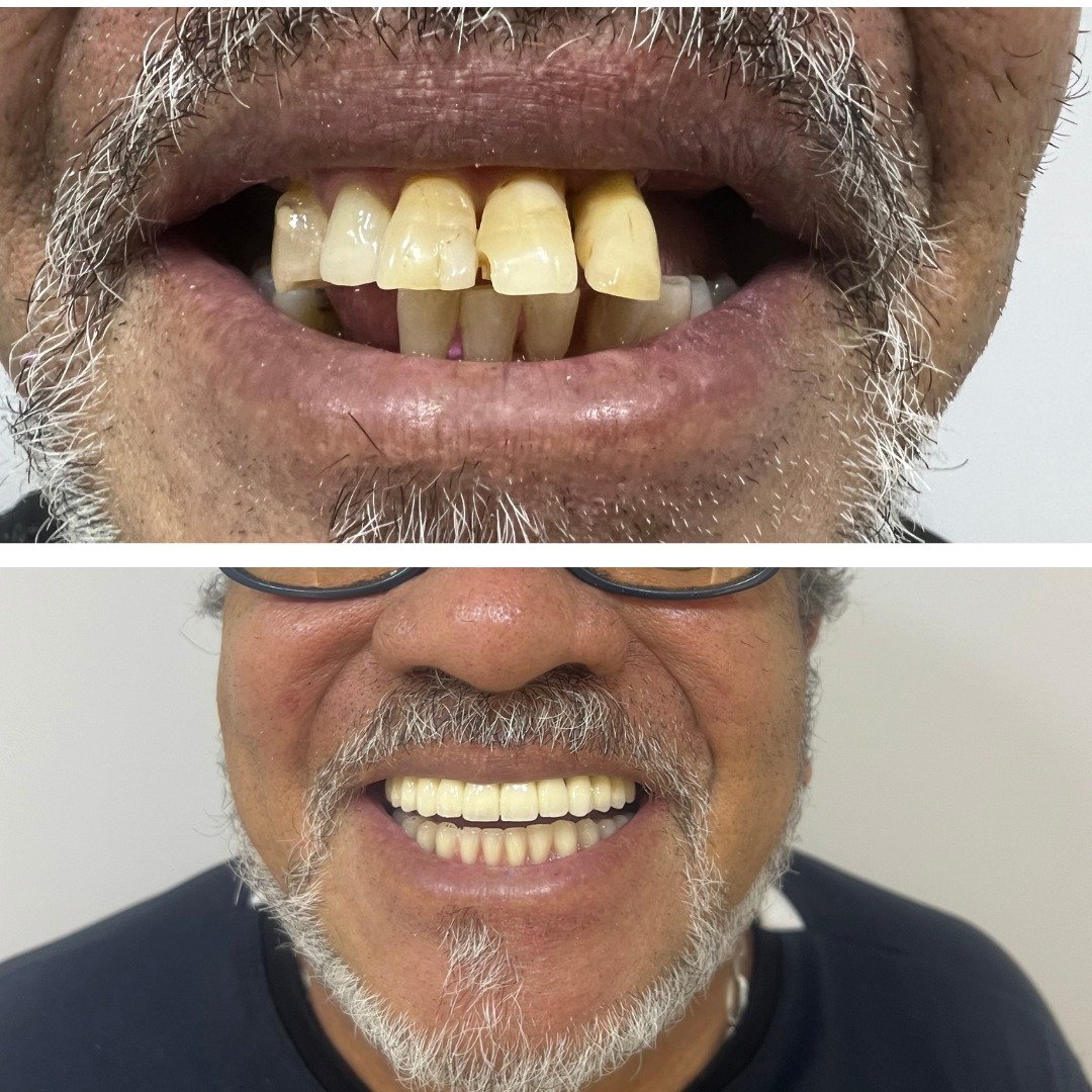Antes e depois — Implantes e prótese · paciente real IEB